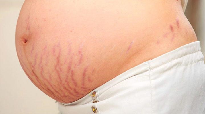 Hầu hết các chị em khi mang thai đều sẽ bị rạn da