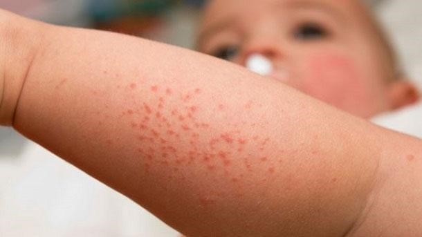 Rôm sảy sẽ làm con khó chịu, nổi các mụn nước