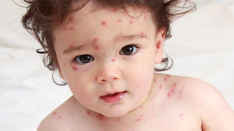 Nến tiến hành cách ly ngay khi phát hiện bé bị bệnh thủy đậu