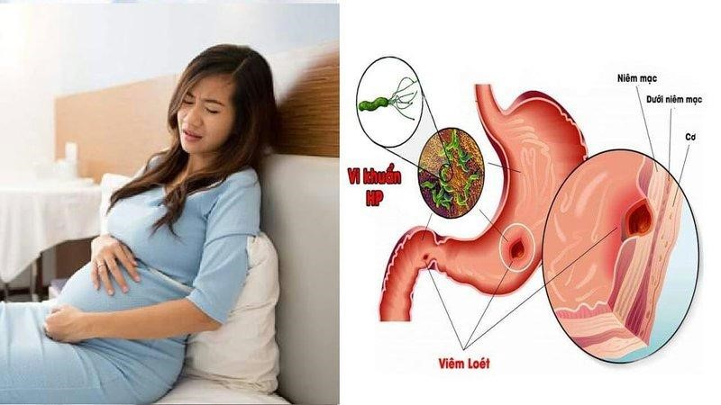Đau dạ dày sẽ khiến mẹ bầu rất mệt mỏi