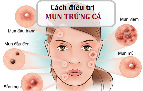 5 Cách trị mụn trứng cá sau sinh hiệu quả